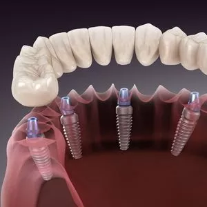 best dental implants near me